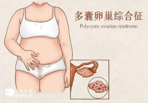 深圳供精试管：多囊做试管到底好不好？看完成功率你就知晓答案！